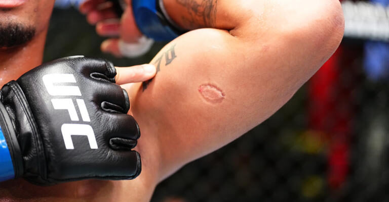 El brazo de Andre Lima luego de la mordida de Igor Severino. © UFC